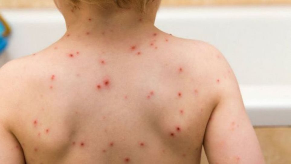 Φόβοι για παγκόσμια έξαρση της ιλαράς, καθώς η πανδημία COVID-19 έχει διαταράξει τους παιδικούς εμβολιασμούς