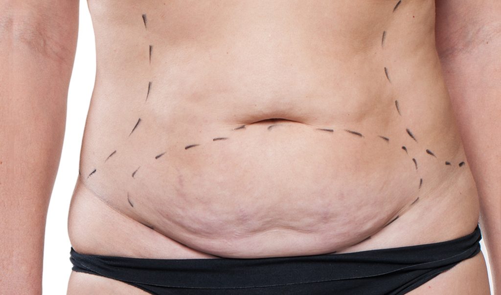Απώλεια βάρους: Πώς να απαλλαγείς από την υπερβολική χαλάρωση