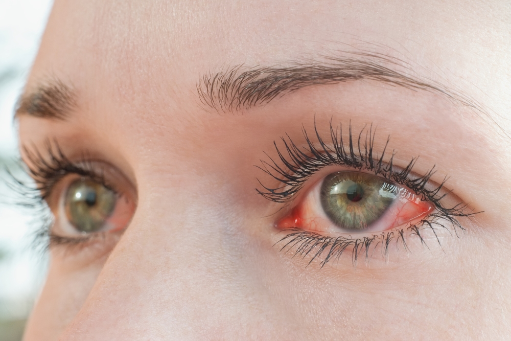 Η ευλογιά των πιθήκων μπορεί να επηρεάσει τα μάτια και την όραση